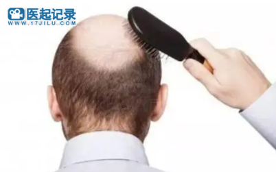缓解脱发的10种方法