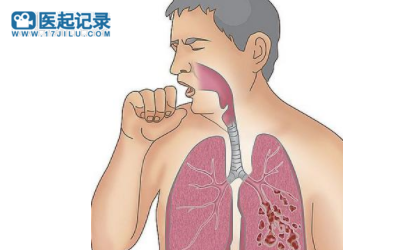 哮喘患者跑步的12条建议