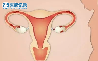 卵巢应该如何保养？
