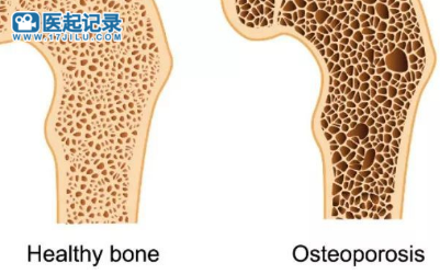 不想骨质疏松？应该做这些运动