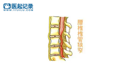 治疗腰椎管狭窄症的6种方法