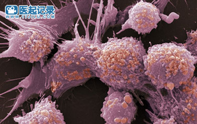 治疗子宫内膜癌的7种靶向药/免疫单抗