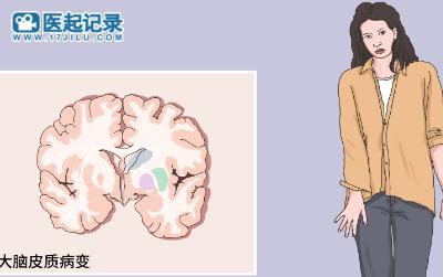 治疗亨廷顿舞蹈病的10种药物