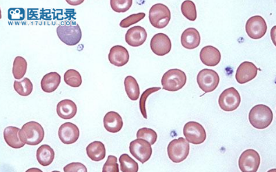 治疗镰刀型细胞贫血病和输血依赖性β地中海贫血药物CASGEVY在英国获批
