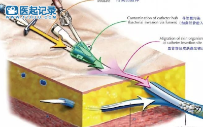 降低导管相关血流感染发生率的药物DefenCath/Taurolidine/Heparin在美国获批