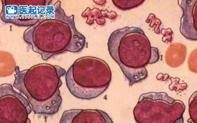 治疗复发或难治性多发性骨髓瘤的药物沙艾特/埃普奈明在中国获批