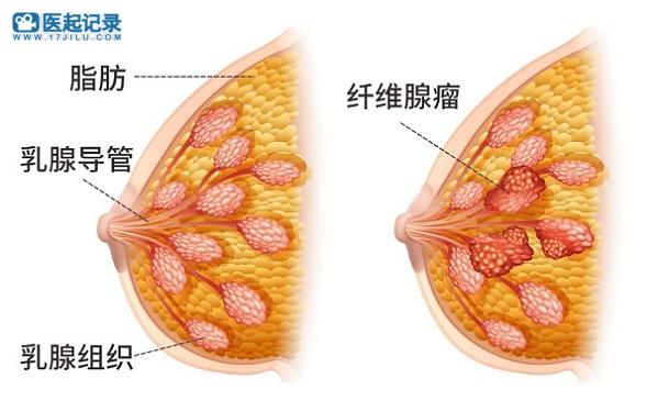 乳腺癌专题